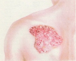 плоска поверхнева базаліома шкіри