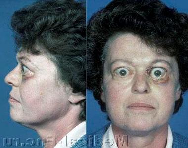 зоб дифузний базедова хвороба