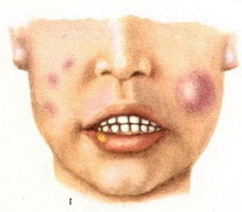 саркоід бека