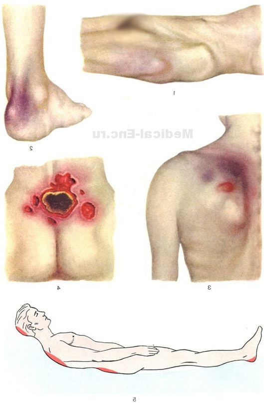 пролежні фото