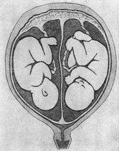 однояйцевая двійня