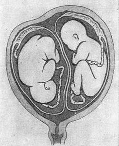 двуяйцевая двійня