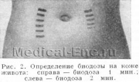 визначення біодози на шкірі живота