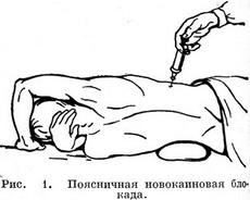 поперекова новокаїнова блокада