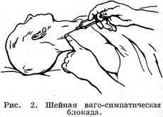шийна ваго-симпатична новокаїнова блокада