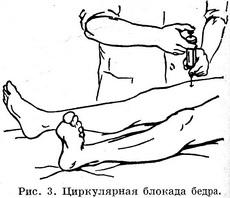 циркулярна блокада стегна
