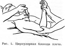 циркулярна блокада плеча
