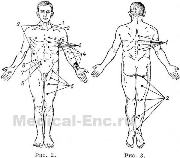 больові точки на тілі людини в картинках