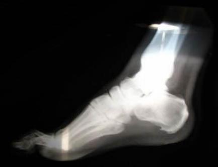 п'яткова шпора фото