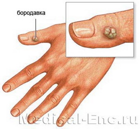 бородавка