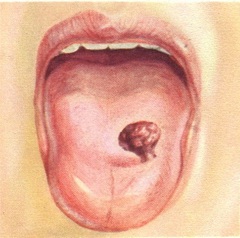 ботриомикома мови