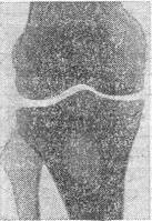 абсцес Броді