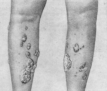 вузлувата (вегетуючих) бромодерма