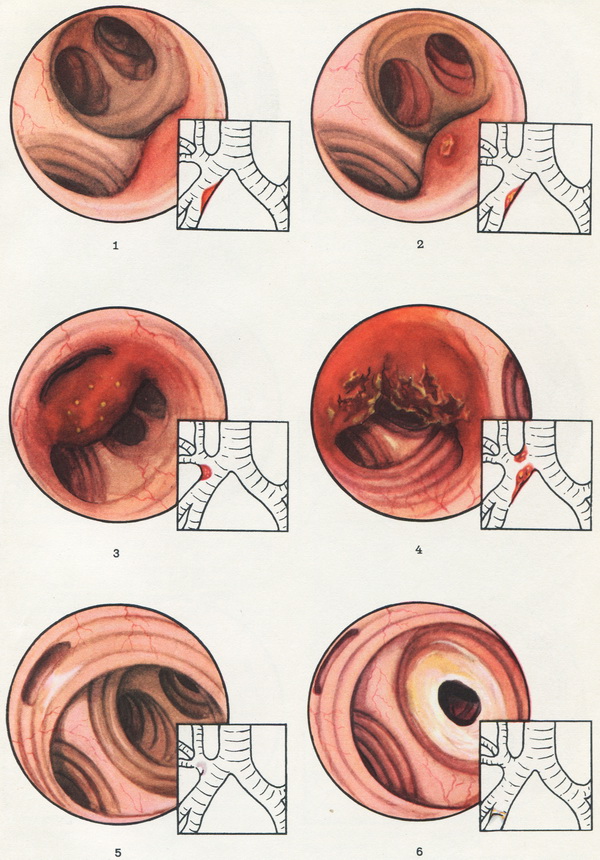 туберкульоз бронхів