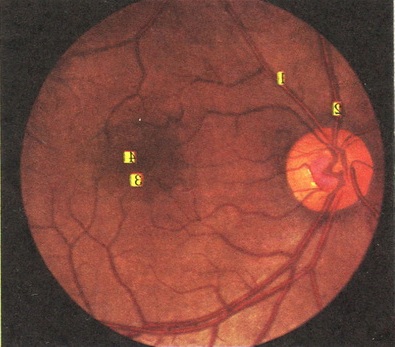 дно очного яблука