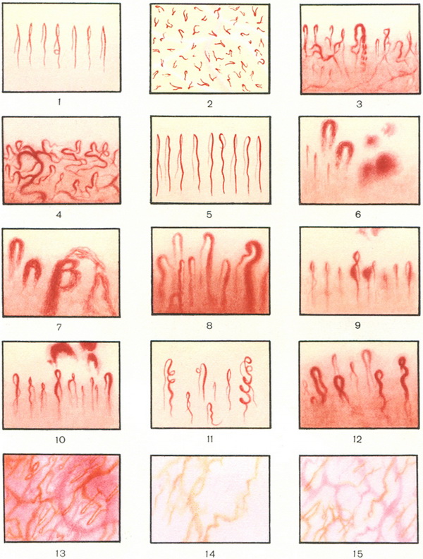 капіляроскопія