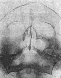 саркома верхньої щелепи