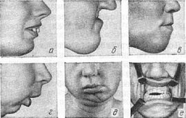 аномалії розвитку щелеп