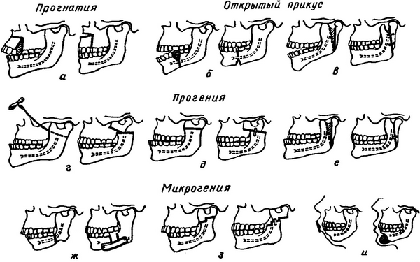 хірургічне лікування деформацій щелеп