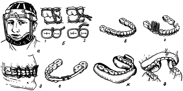 методи іммобілізації відламків при переломах нижньої щелепи