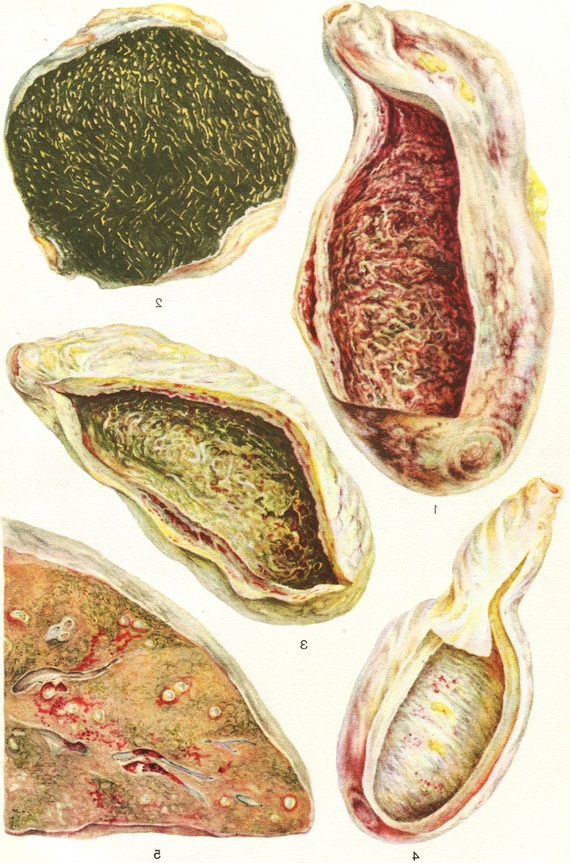 холецистит