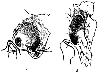 холестеатома