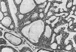 цилиндрома м'якого неба