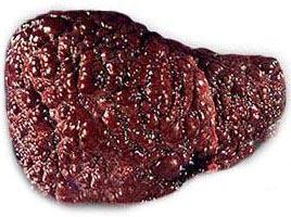 цироз печінки