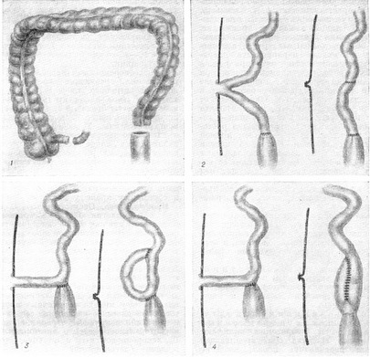 илео-ректальний анастомоз