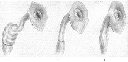 накладення проктостомы при ускладненому виразковому неспецифічному коліті