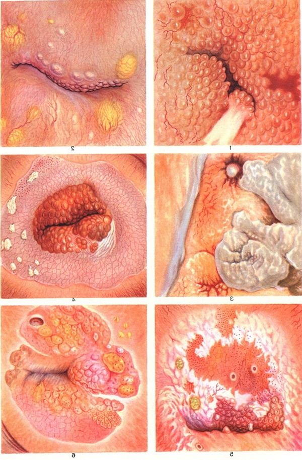 кольпоскопія шийки матки