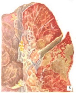 зливна бронхопневмонія