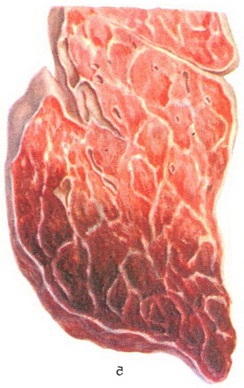 застійна пневмонія