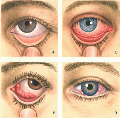 кон'юнктивіт