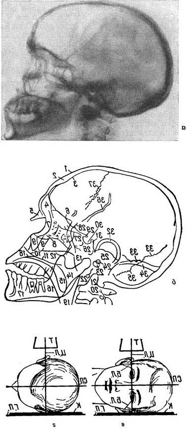 оглядова рентгенограма черепа в правій бічній проекції