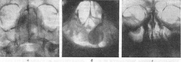 рентгенографія м'яких тканин черепа