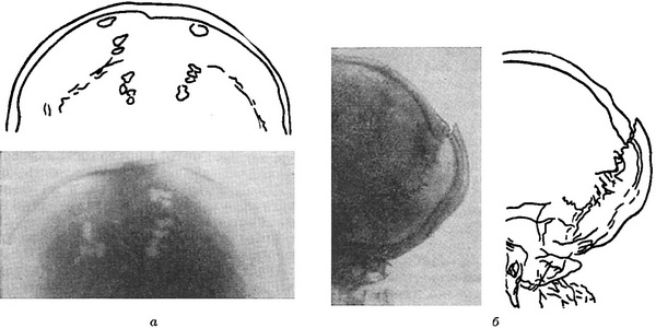 рентгенограми і відповідні їм схеми черепа
