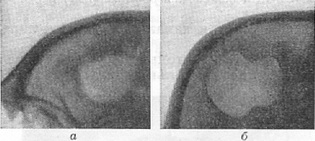 дефекти в кістках черепа