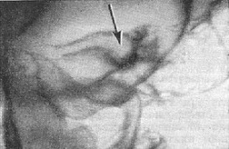 невринома правого слухового нерва