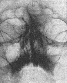 гострий синуит