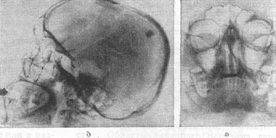 рентгенограми черепа при обызвествленной гематомі