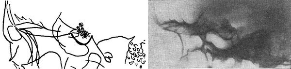 краниофарингиома