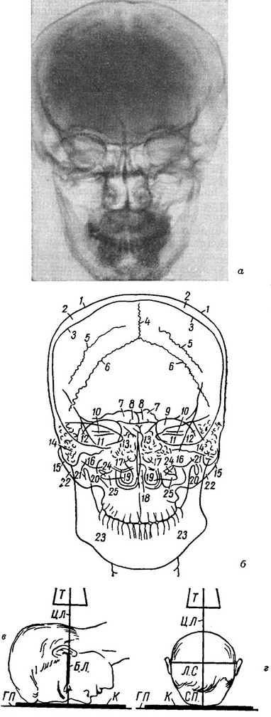 рентгенограма черепа в передній прямій проекції