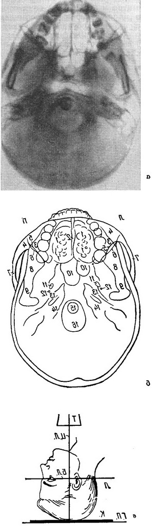 рентгенограма черепа в задній аксіальної проекції