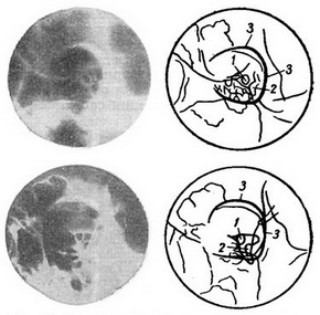 рентгенограми лівого нормального зорового каналу