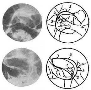 ретробульбарно пухлина лівої очниці