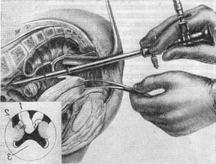 кульдоскопия