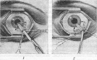 циклодиализ