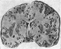 цистицеркоз головного мозку