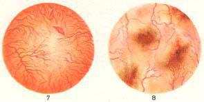 гострий цистит